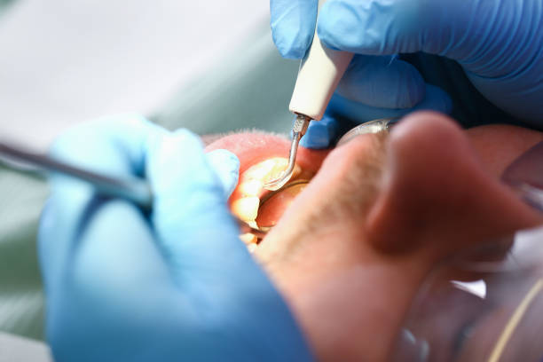 Best Emergency Wisdom Tooth Extraction in Spencer, TN